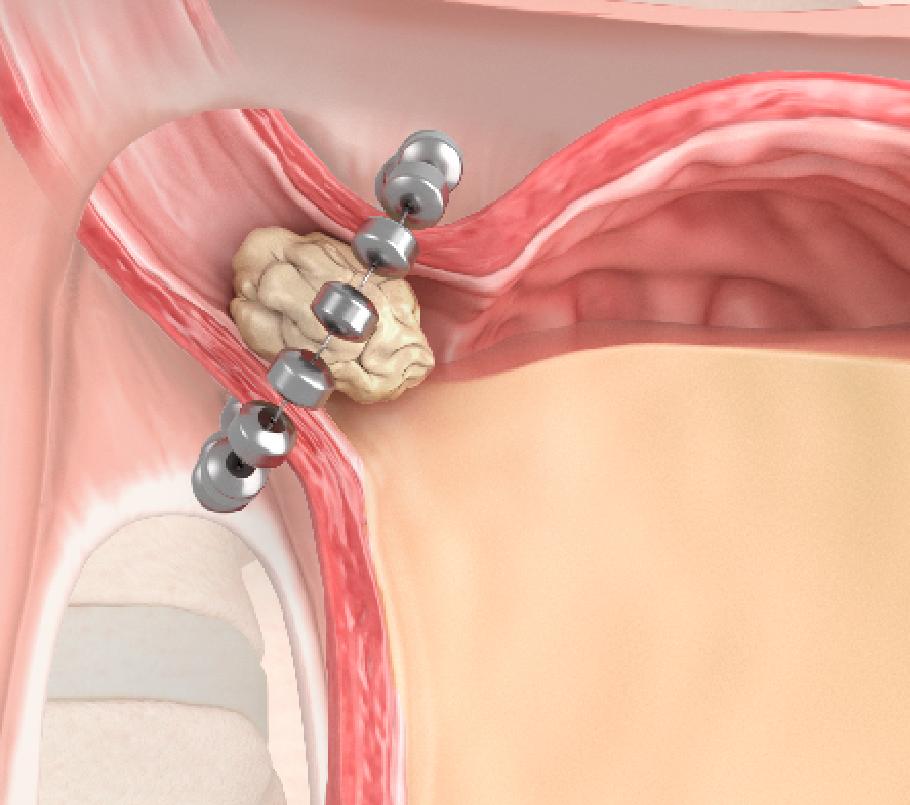 A short outpatient procedure